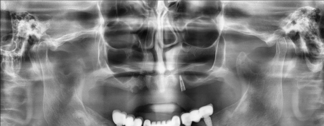 dental implants in Patna