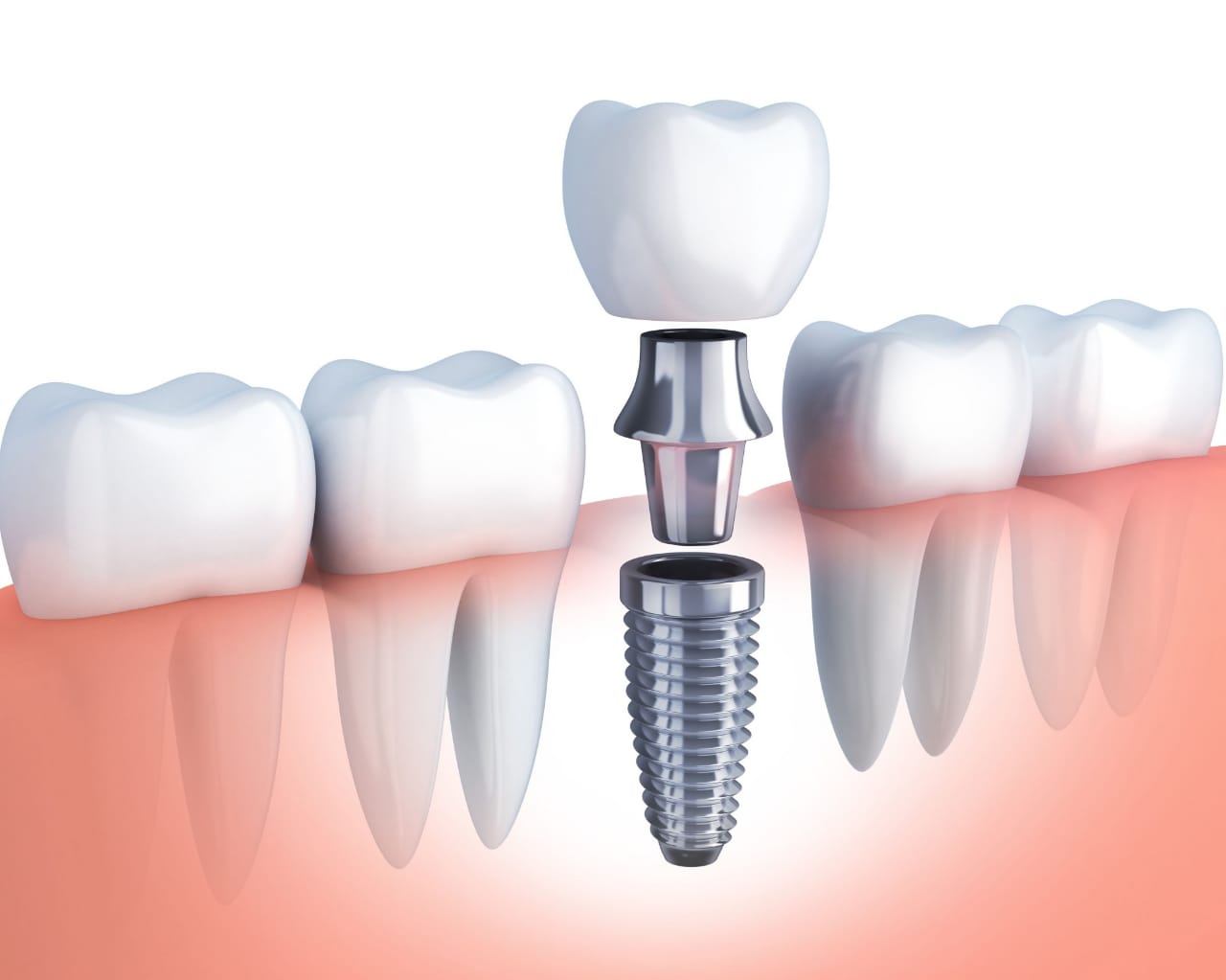 dental implants in Patna