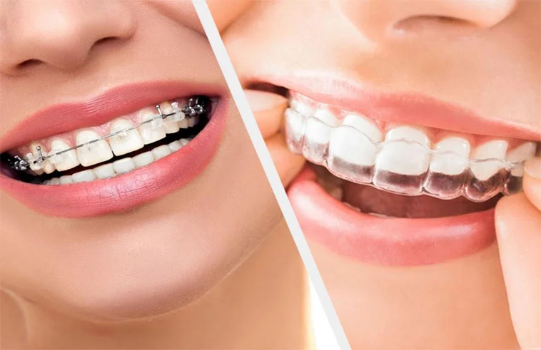 Orthodontics in Patna
