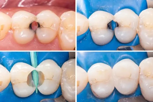 Cosmetic Dental Fillings in Patna